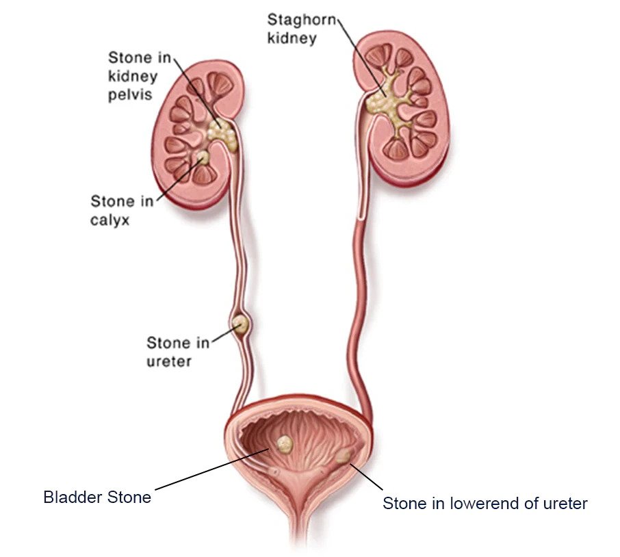 Ureteric stone deals treatment